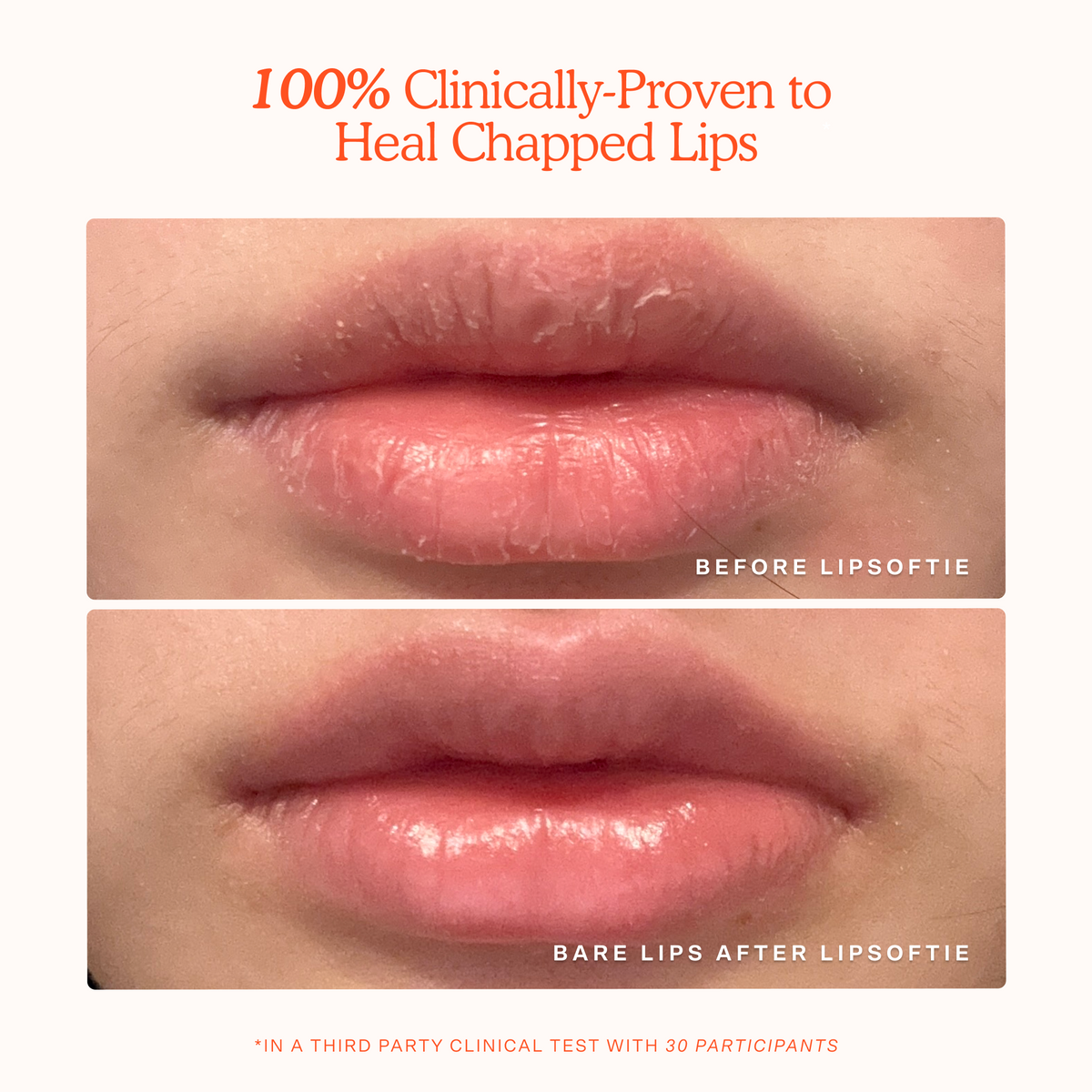 LipSoftie® Lip Treatment O9