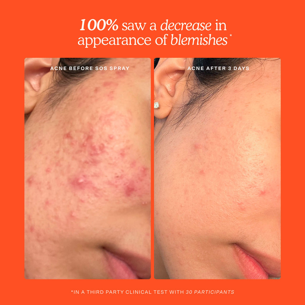SOS Skincare Minis Kit T6