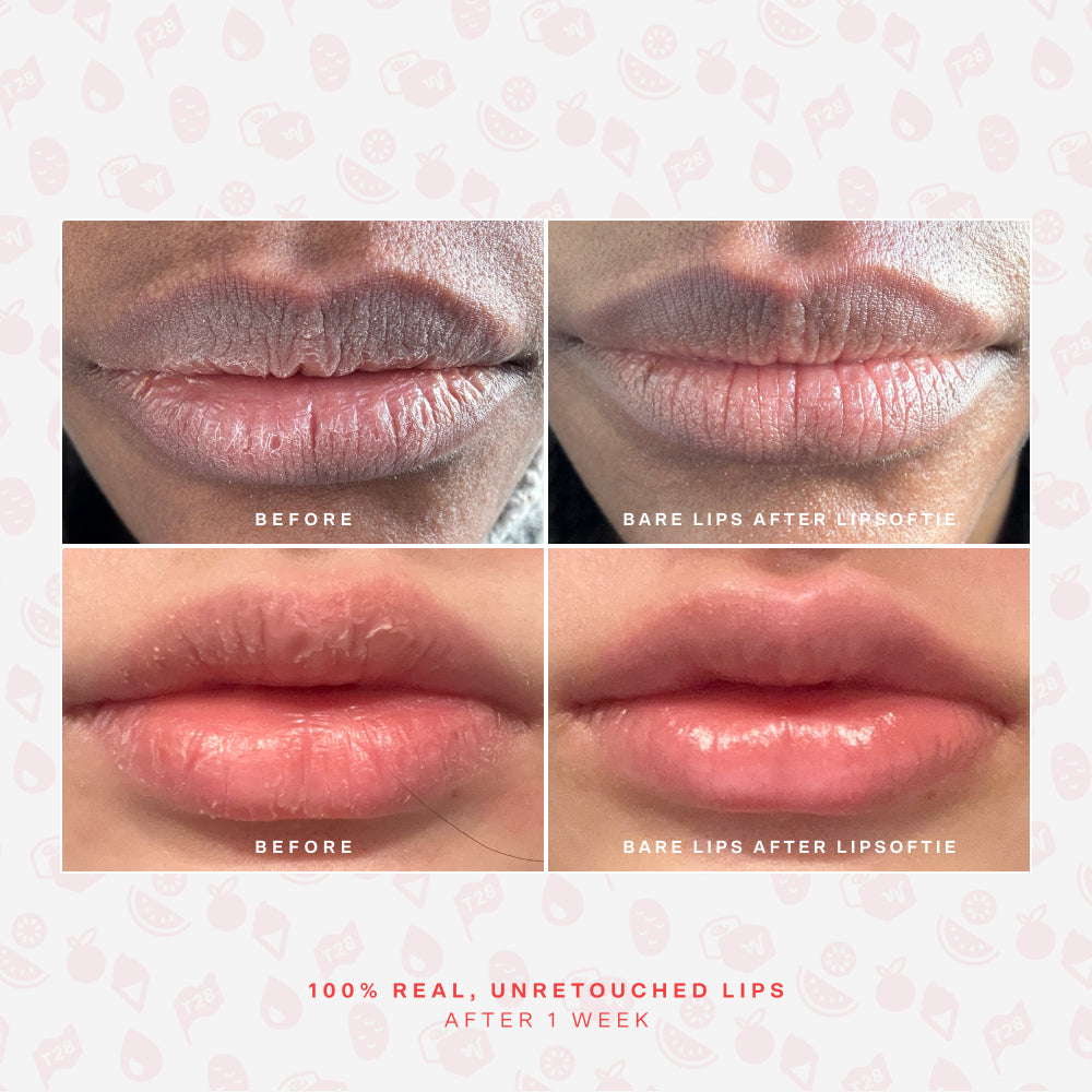 SOS LipSoftie® Lip Treatment R7
