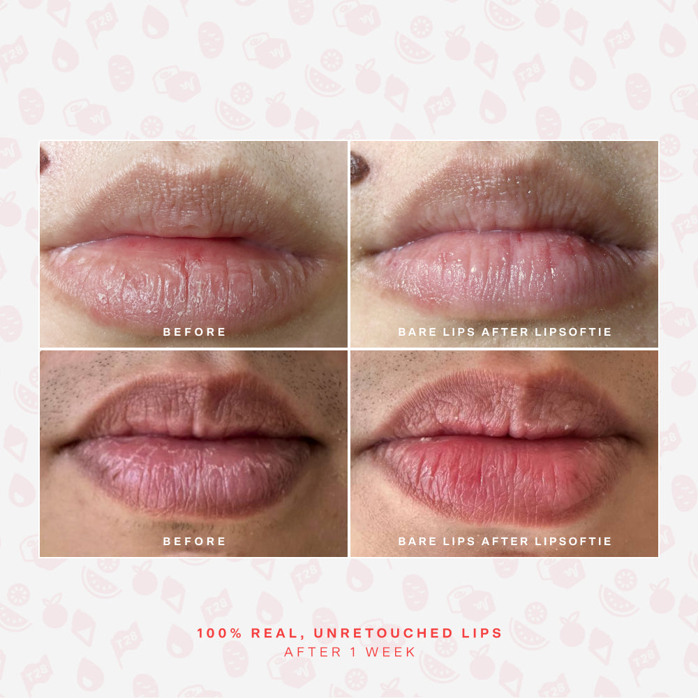 SOS LipSoftie® Lip Treatment R7